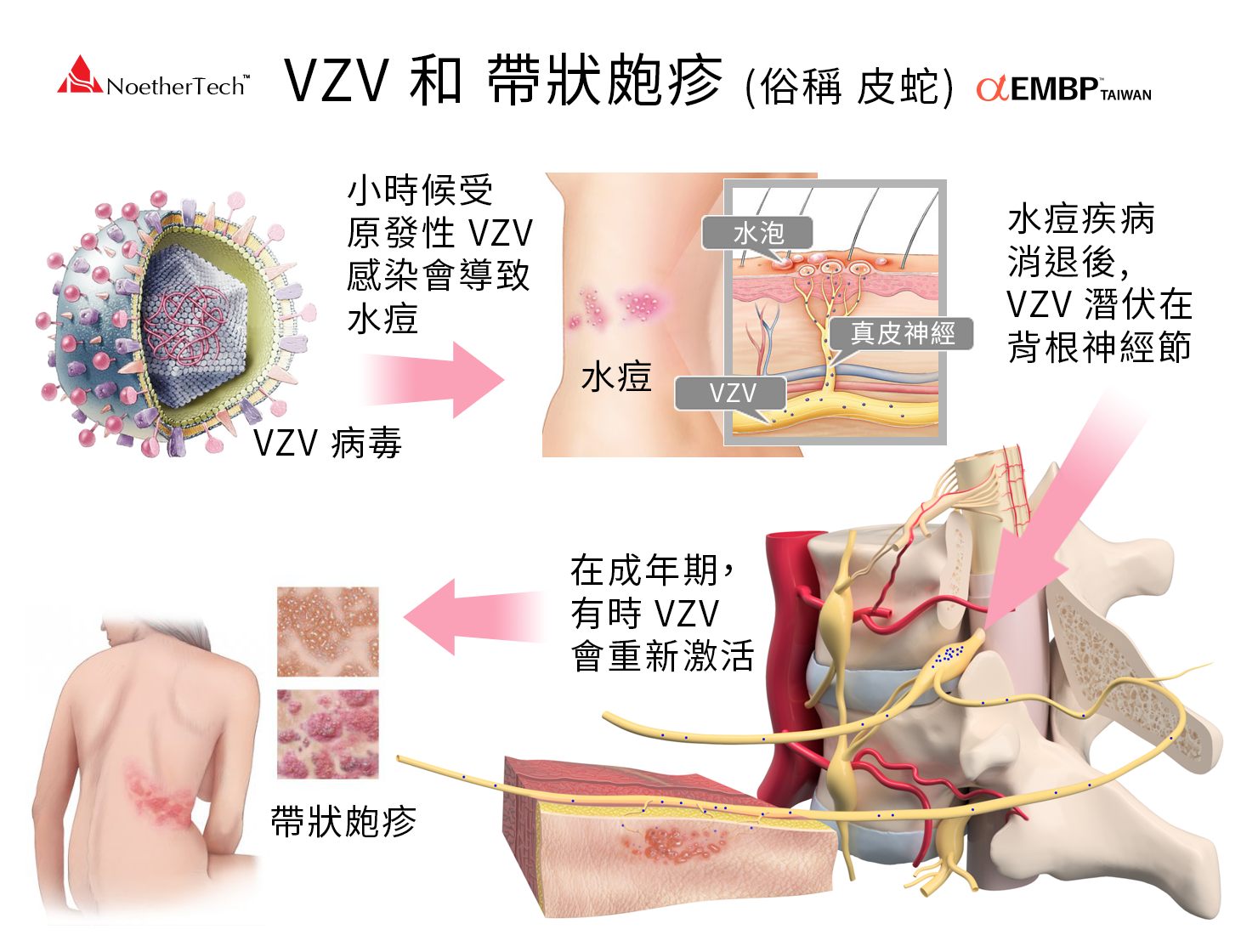 帶狀皰疹