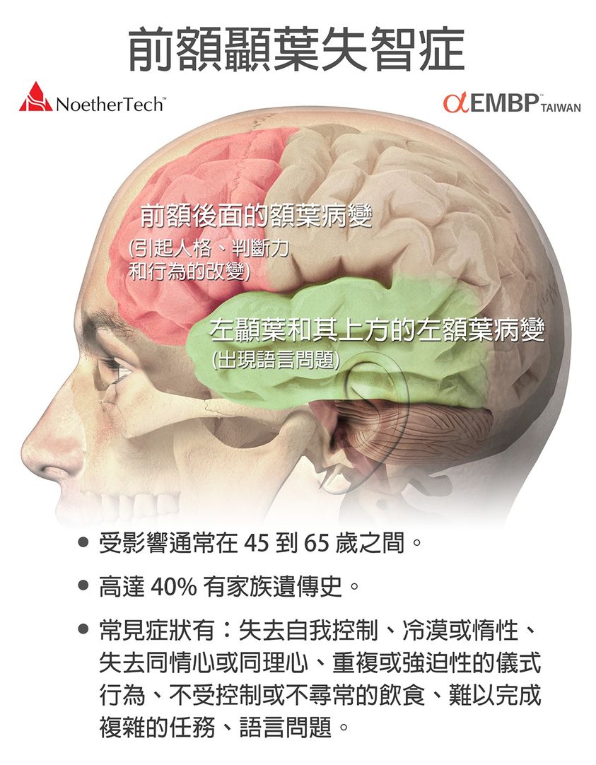 前額顳葉失智症