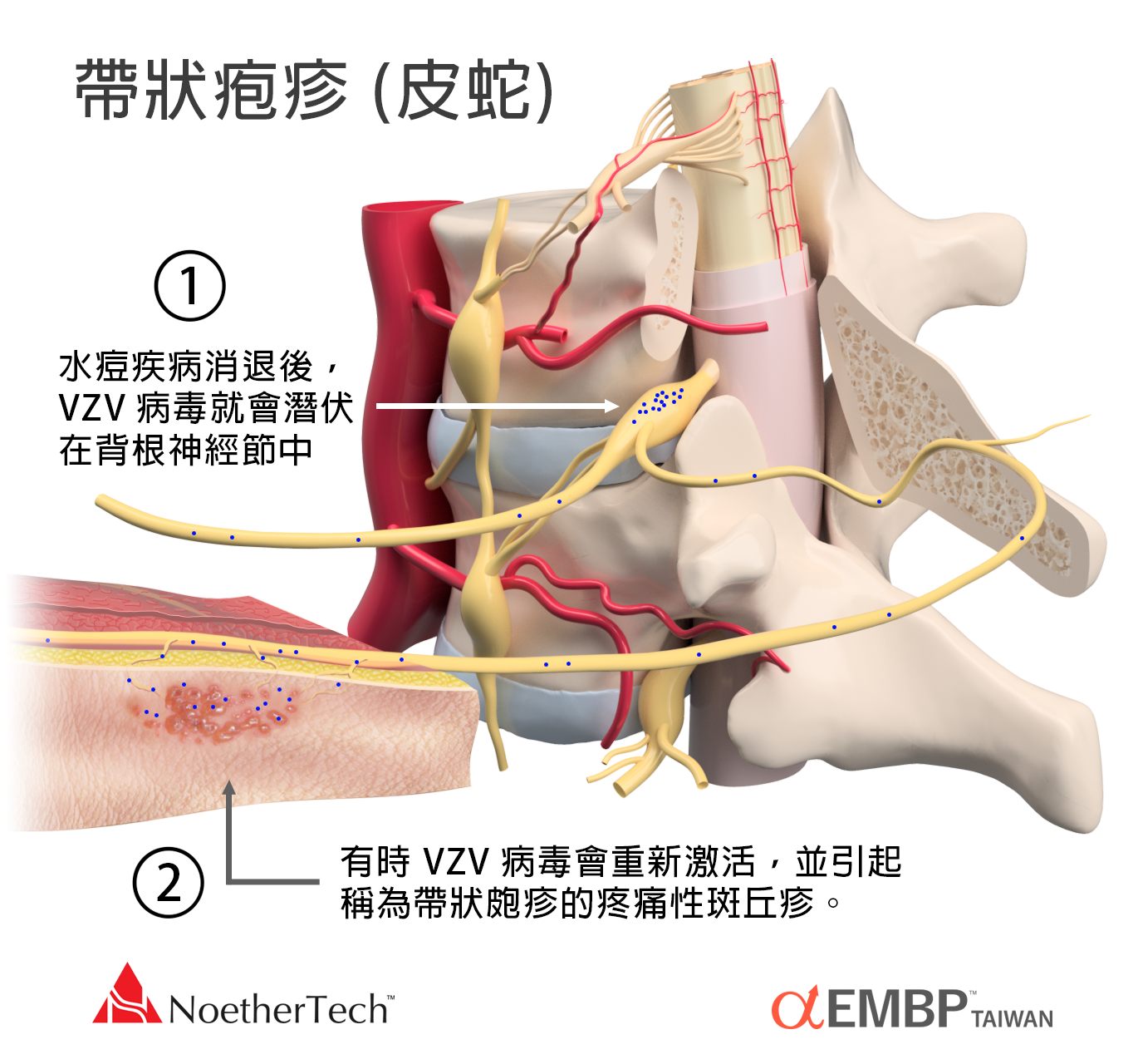 帶狀皰疹