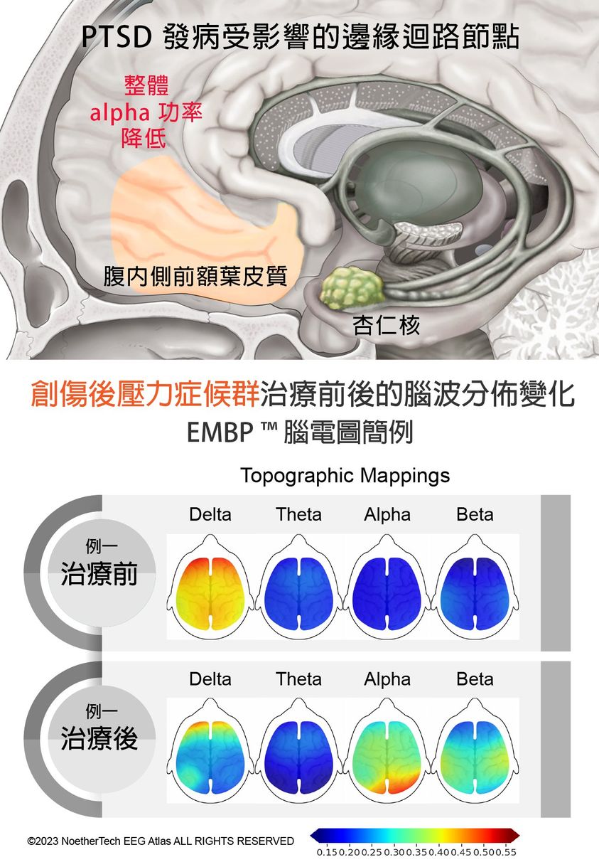 創傷後壓力症候群(PTSD)