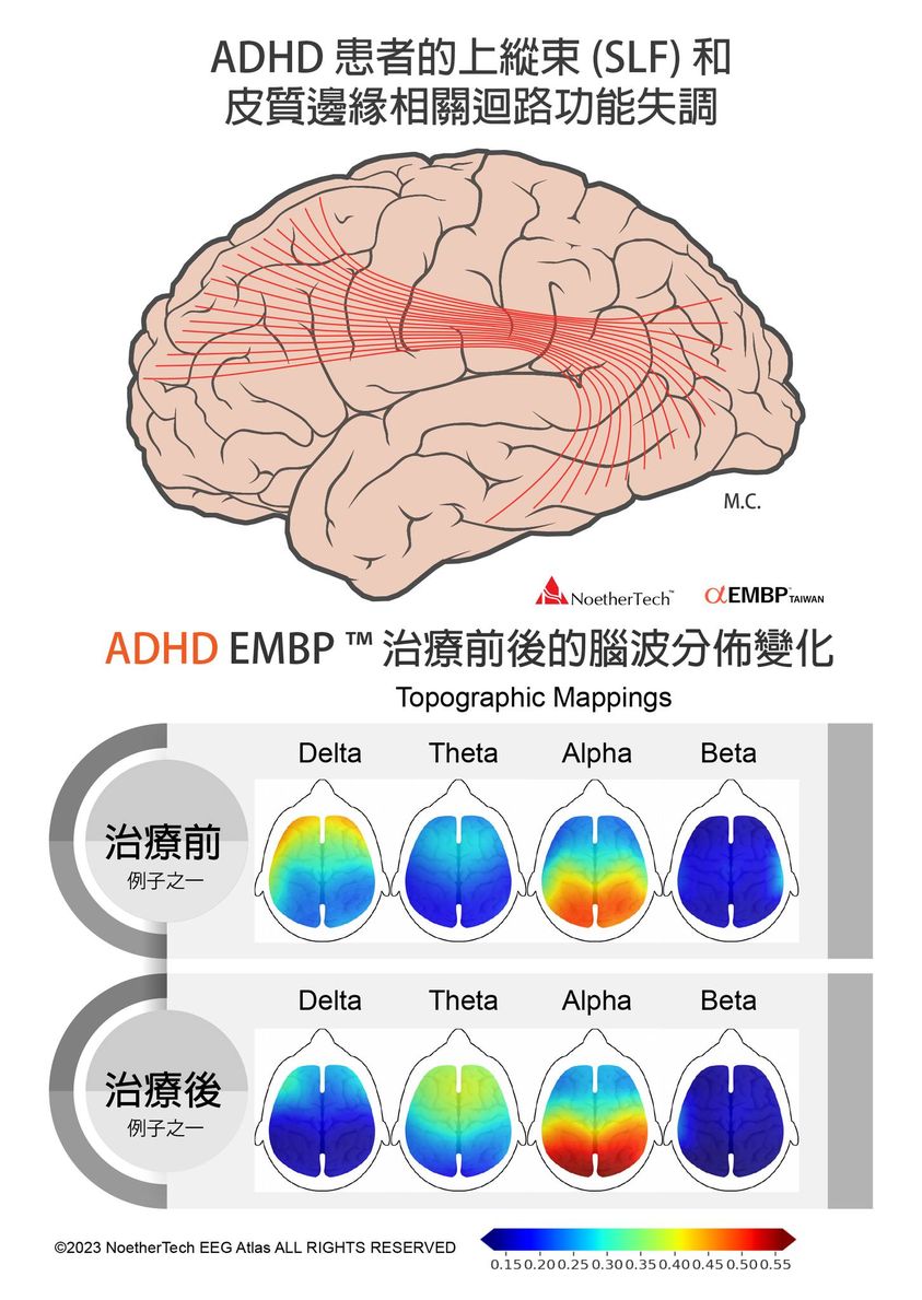 ADHD注意力不足過動症