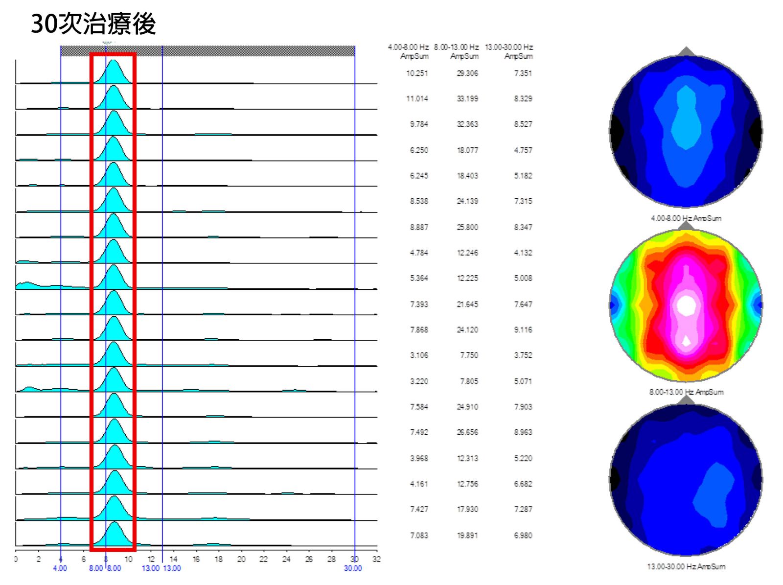 案例分享：案例一55歲女性(30次治療)